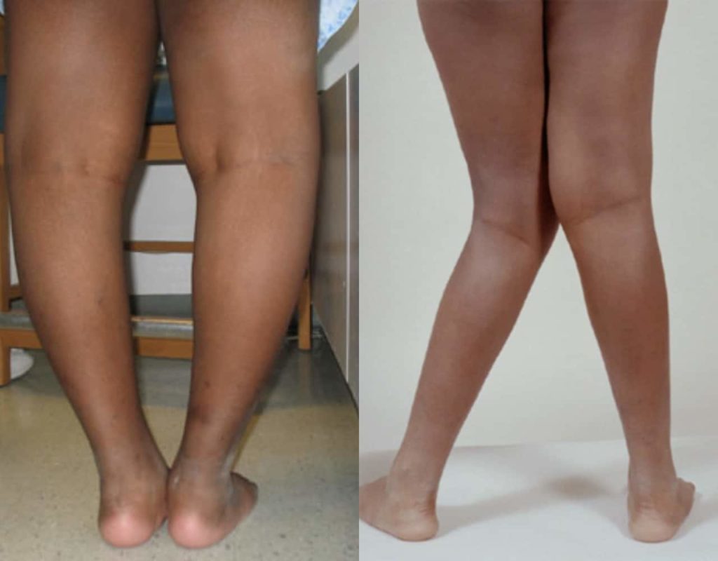 How to deal with ‘bow, K-leg’ syndrome – Medical Expert