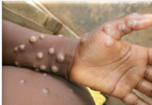 Monkeypox breakout in DR Congo