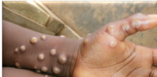 Monkeypox breakout in DR Congo