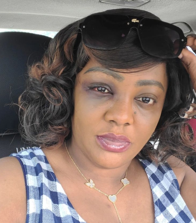 Helen Paul Shares Photo Of Bruised Face After Car Accident