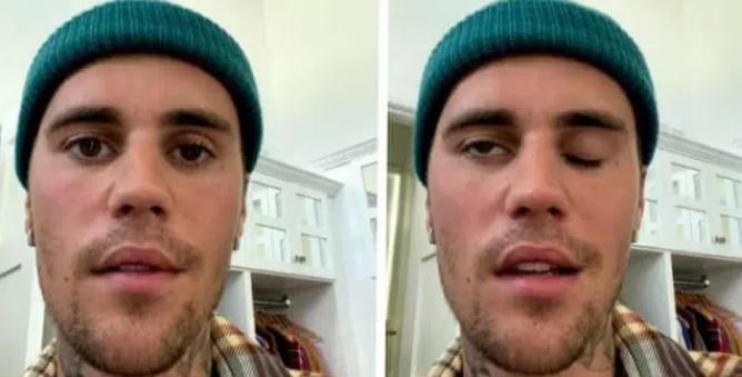 Justin Bieber Diagnosed With Ramsay Hunt Syndrome (Video)