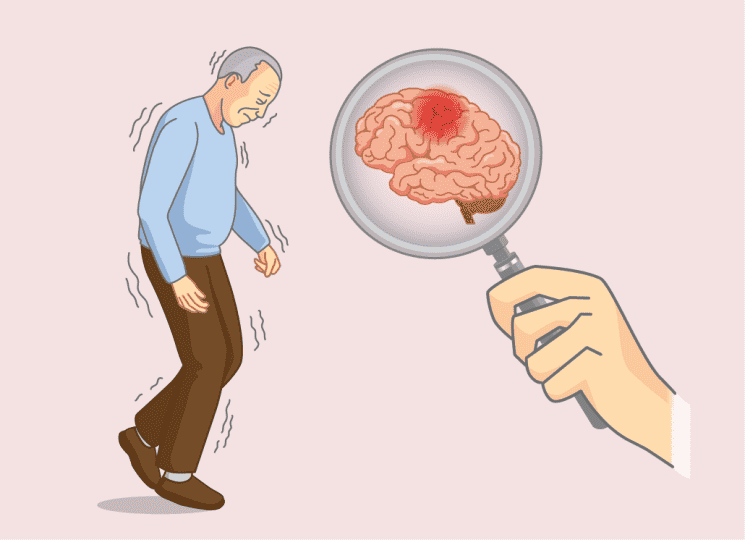 Key Things to Know About Alzheimer's Disease