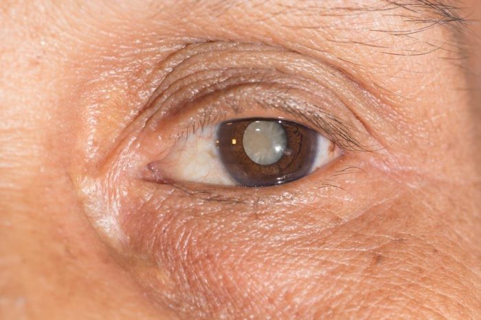 Protecting Your Vision: Effective Ways to Prevent Eye Cataracts