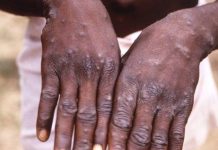 Fear As Deadly Chickenpox Kills Many In Abuja Community