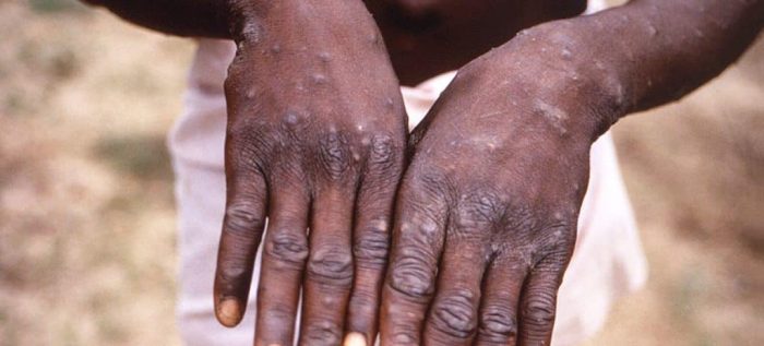 Fear As Deadly Chickenpox Kills Many In Abuja Community