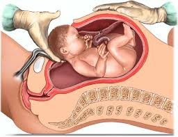 Cesarean Section: Who Decides? Man Or Wife?