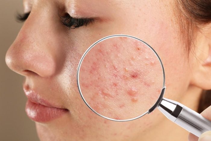 How To Care For Your Face When You Have Pimples