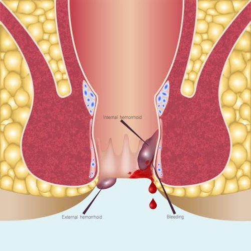 Hemorrhoids