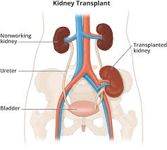 Causes Of Kidney Failure