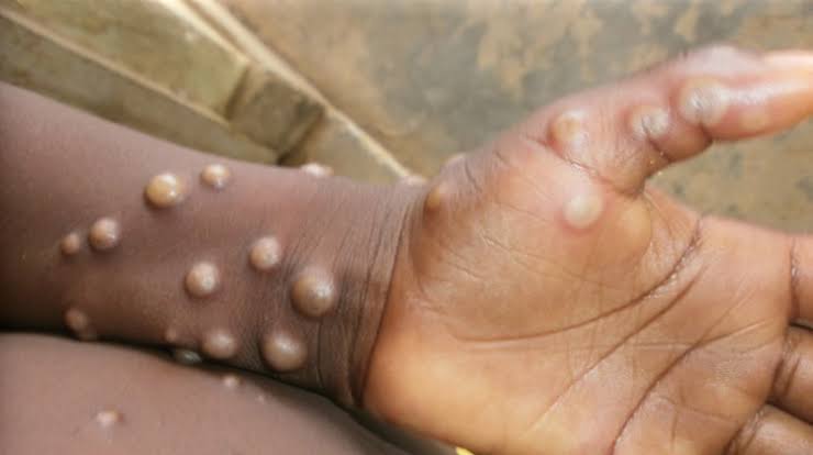 Mpox: FG Tightens Border Controls In Response To Global Outbreak