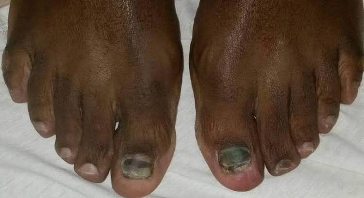 Toenail Fungus: Prevention And Cure