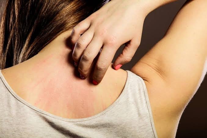 Effective Ways For Treating Scabies