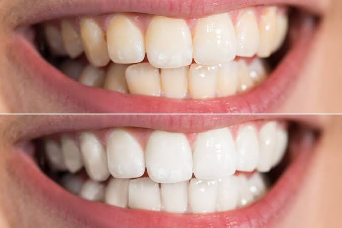 5 Natural Methods For Teeth Whitening