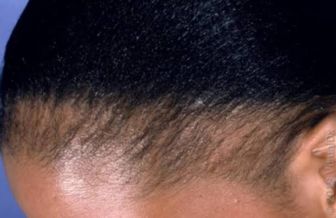 Alopecia: 7 Tips On How To Grow your Hair Edges