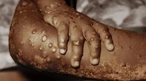 Ghana Confirms First Mpox Case Of 2024