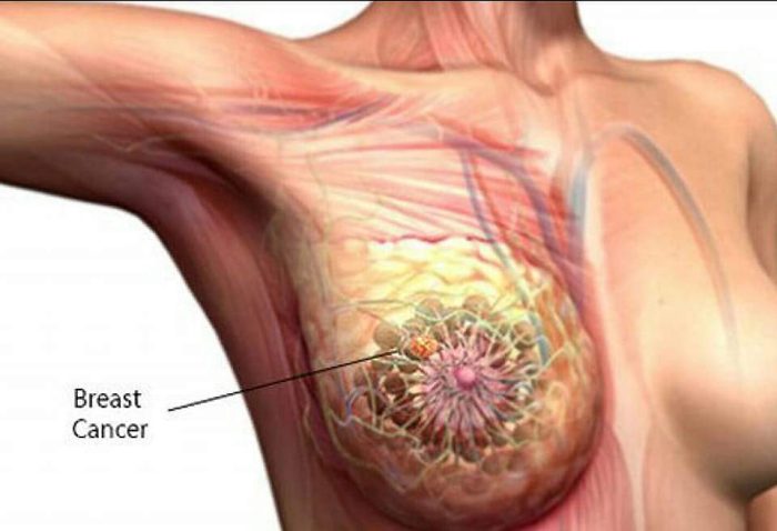 4 Facts About Breast Cancer You Might Not Know