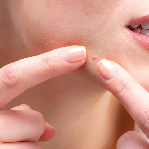 3 Reasons You Shouldn’t Pop Your Pimple